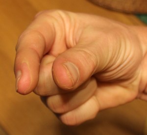 Pictured two weeks after a 5-minute Raynaud's episode are the fingers of the editor. The tips are still numb and hurt a little.