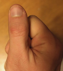 If you look close, you could see black vertical lines near the tip of the thumbnail. That is where blood vessels were damaged. The same thing can happen if you bang your nail too hard. 